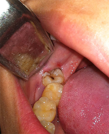 La foto mostra un dente del giudizio inferiore della carie inferiore.