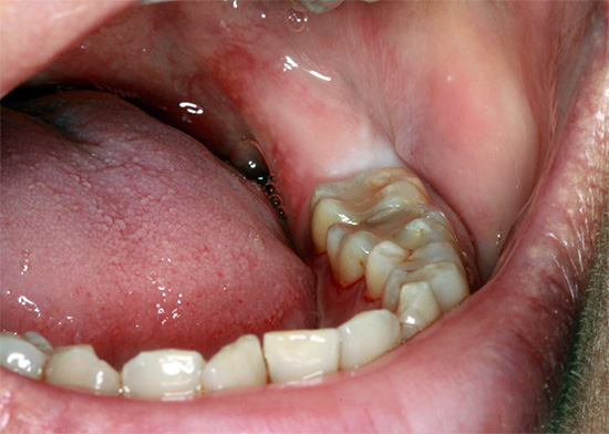 Il dente del giudizio ritardato non è visibile, poiché è completamente nascosto sotto la gomma.