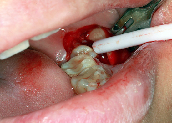 Quando i bordi della gomma tagliata vengono spostati, il dente del giudizio precedentemente nascosto diventa visibile.