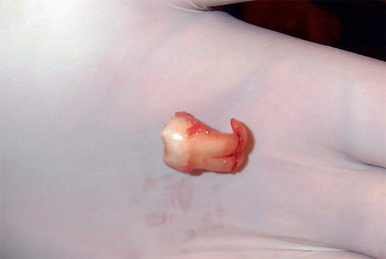 Le radici dei denti del giudizio possono essere piegate nel modo più incredibile ...