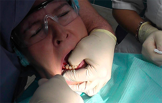 Poiché il medico esercita una forza considerevole durante la rimozione del dente, lo scivolamento dello strumento a volte porta a gravi lesioni dei tessuti molli circostanti.