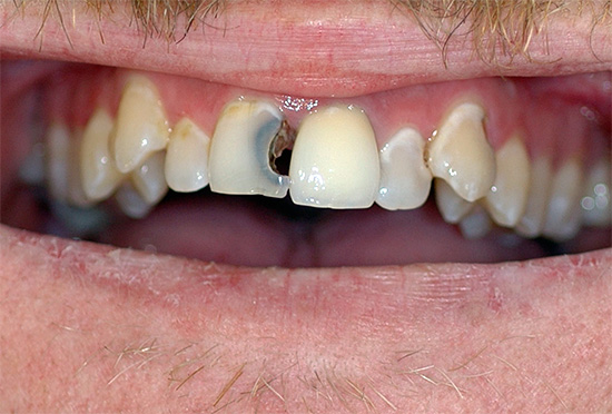 Com dor de dente severa, é melhor usar outro medicamento mais poderoso.