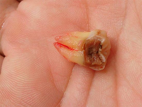 Vamos falar sobre as características da remoção dos dentes do siso localizados na mandíbula, bem como sobre as possíveis conseqüências dessa intervenção cirúrgica ...