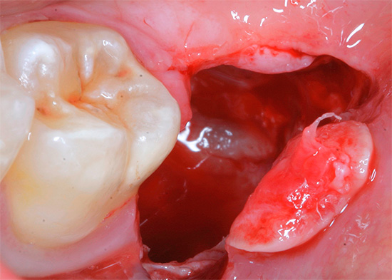 Entre as conseqüências desagradáveis ​​da extração dentária está o sangramento prolongado do orifício, cujo sangue pode não parar por várias horas ou até um dia.