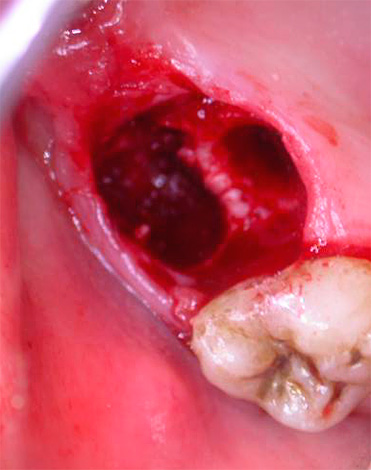 Um problema bastante sério que às vezes surge após a extração dentária também é alveolite - inflamação das paredes do buraco.