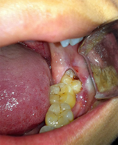 A foto mostra um dente de sabedoria inferior afetado por cárie profunda, parte da qual está escondida sob a gengiva.