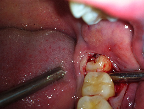 Na maioria dos casos, os oitavos dentes inferiores são muito mais difíceis de remover do que os oito na mandíbula superior.