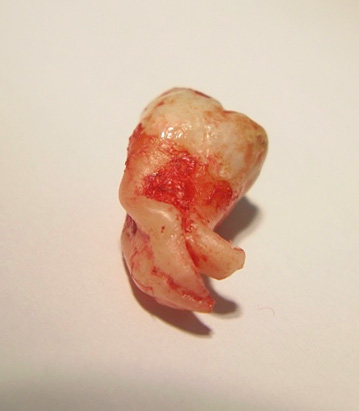 As raízes dos dentes do siso podem ser bastante bizarras ...