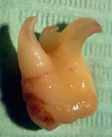 Um grande número de raízes curvas cria certas dificuldades na extração dentária, portanto, é longe de ser sempre possível simplesmente retirá-lo com uma pinça.
