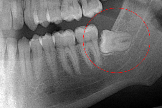 O raio-x mostra claramente como exatamente o dente do siso está localizado na mandíbula - isso facilita o trabalho do médico e reduz o risco de possíveis erros.