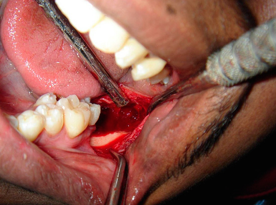 Nesta fotografia, é claramente visível que, no lugar do dente do siso removido, permanece uma ferida bastante significativa na área.
