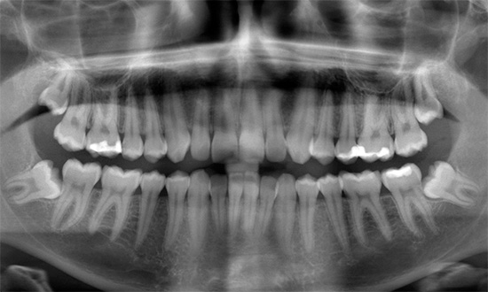 O crescimento inadequado dos dentes do siso pode atrapalhar significativamente a mordida.