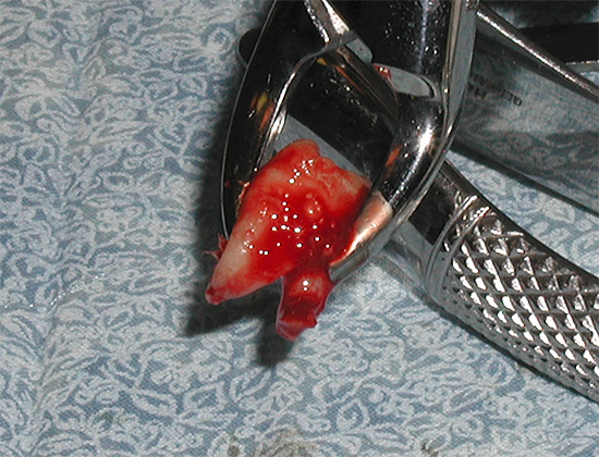 A remoção dos dentes do siso localizados na mandíbula superior tem suas próprias especificidades, sobre as quais falaremos mais adiante ...