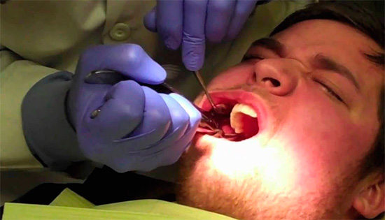 Infelizmente, há casos em que um médico, ao remover um dente do siso, quebra ou desloca um (sétimo) vizinho.