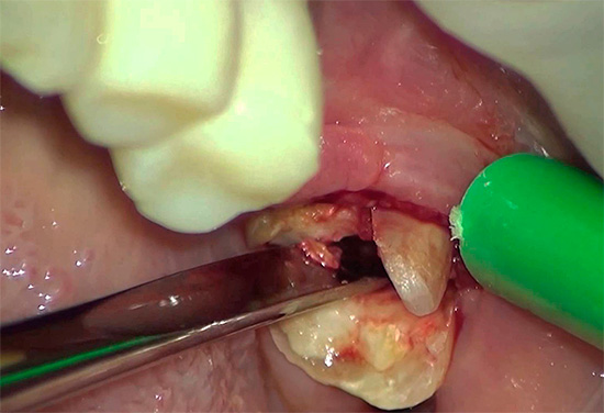 A memória dos métodos da odontologia soviética leva ao fato de que algumas pessoas estão em pânico com medo de remover os dentes.