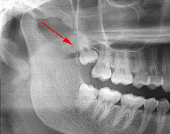Às vezes, os dentes do siso, superiores e inferiores, podem ser parcial ou completamente escondidos sob a gengiva.