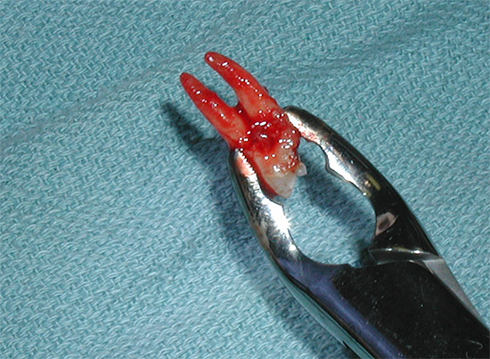 Com engenhosidade e destreza adequadas, os cirurgiões dentistas conseguem usar uma pinça em forma de baioneta para remover os dentes superiores e inferiores.