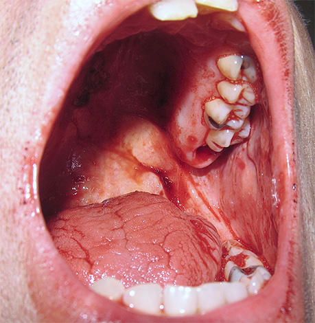 O orifício de sangramento no lugar do dente do siso removido da mandíbula superior é claramente visível na fotografia.