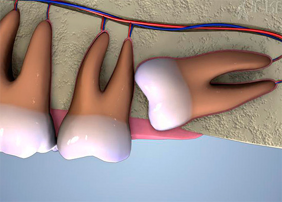 A figura mostra uma representação esquemática do dente do siso retardado superior.