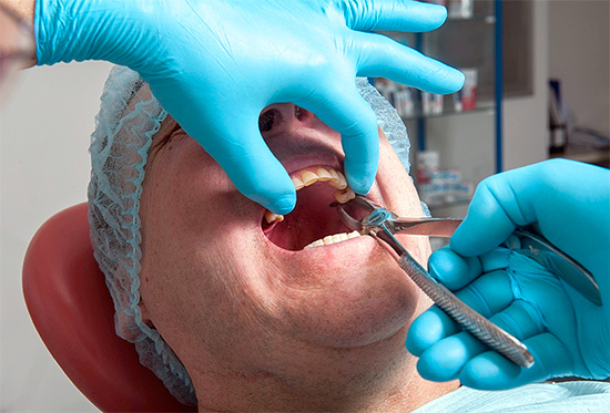 Se o dente do siso não estiver oculto sob a gengiva e puder ser segurado com segurança pela pinça pela coroa, geralmente o procedimento de remoção é rápido e fácil.