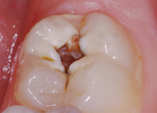 A inserção de alho na cavidade só intensificará a dor de dente ...