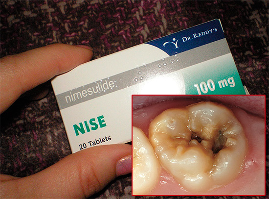 Vamos falar sobre o uso de comprimidos Nise para aliviar a dor de dente - este medicamento realmente ajuda e também o que é importante saber antes de usá-lo ...