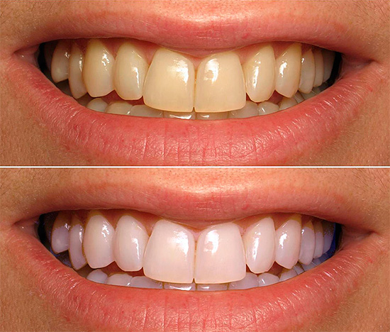 O clareamento dos dentes é a maneira mais eficaz (a foto mostra o estado da zona do sorriso antes e depois do procedimento).