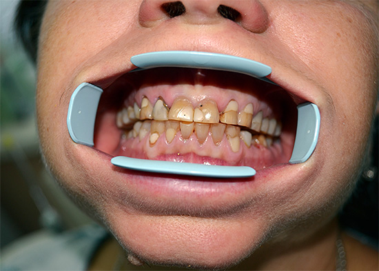A presença de um grande número de obturações e focos cariados é uma contraindicação ao clareamento dos dentes de maneira química.