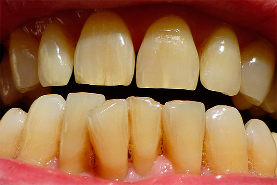 Antes de começar a clarear os dentes, é útil começar a descobrir qual método será preferível na sua situação.
