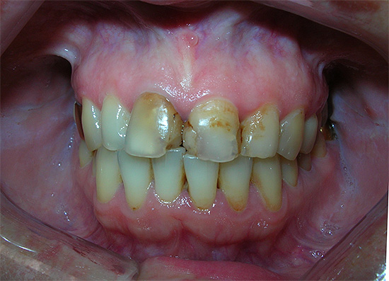 A presença de restaurações antigas no método químico de clareamento dos dentes pode levar ao vazamento do gel nas microfissuras, o que às vezes causa dor intensa.