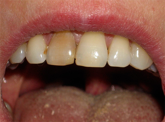 O clareamento intracanal permite clarear os dentes mortos escuros.