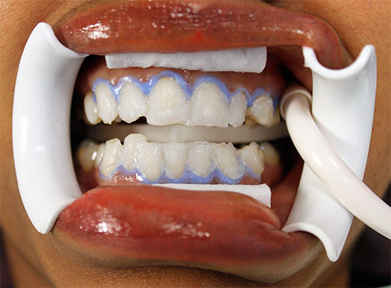 A foto mostra um exemplo de clareamento de dentes químicos no consultório do dentista.