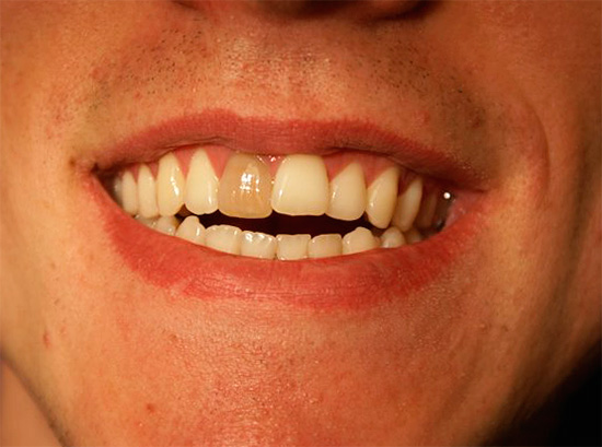Fotografia de um dente morto escuro antes do procedimento de clareamento.