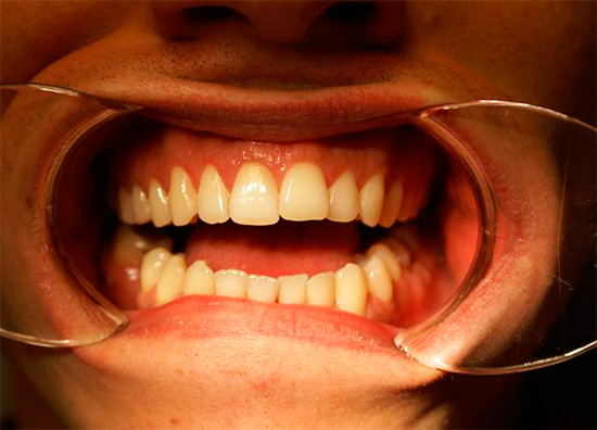 E o mesmo dente se parece com o clareamento do endotélio.