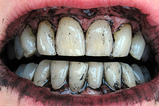 O clareamento dentário de carvão ativado raramente é eficaz.