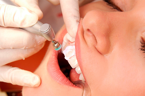 Com o clareamento mecânico, os depósitos manchados - placa e pedra - são removidos da superfície dos dentes.