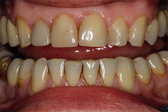 Com uma abundância de tártaro e placa bacteriana, é aconselhável realizar uma higiene bucal profissional - isso imediatamente tornará a zona do sorriso mais branca.