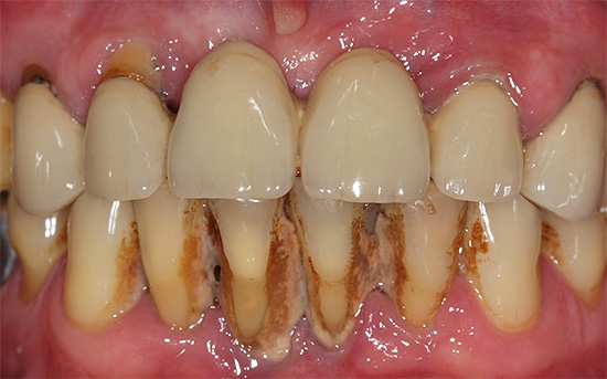 A foto mostra um exemplo de tártaro abundante nos dentes inferiores da frente.