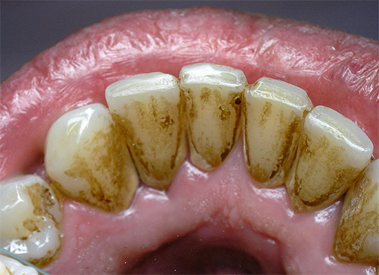 O tártaro geralmente se acumula na superfície interna dos dentes anteriores inferiores.