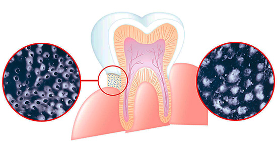 A figura mostra esquematicamente como os sais de estrôncio, cálcio e fluoreto podem reduzir a sensibilidade do dente ao entupir os túbulos dentinários.