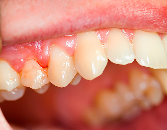 Os cremes dentais de Mexidol são focados principalmente no tratamento e prevenção de doenças gengivais (periodontite, doença periodontal, gengivite, etc.)