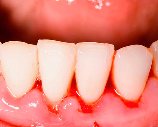 Os cremes dentais de Pomorin são especialmente populares como um meio de combater a inflamação e o sangramento das gengivas.