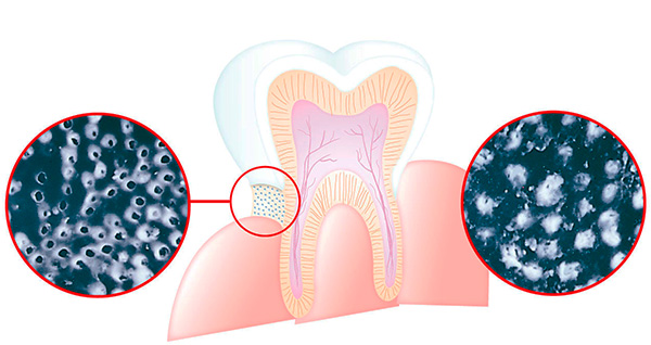 A imagem mostra como o acetato de estrôncio ajuda a reduzir a sensibilidade do dente.