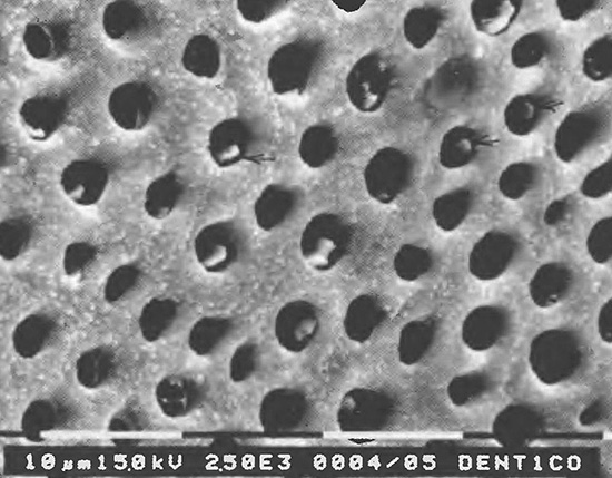 Fotografia da dentina sob um microscópio eletrônico - as bocas dos túbulos dentinários são visíveis.