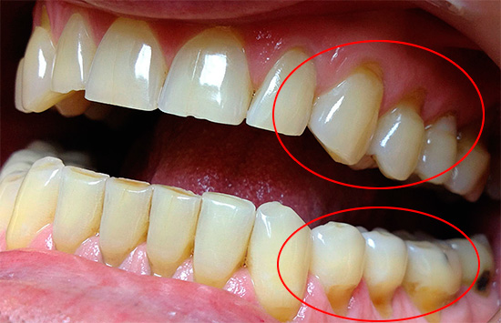 A foto mostra defeitos em forma de cunha na zona cervical - geralmente causam maior sensibilidade dos dentes.