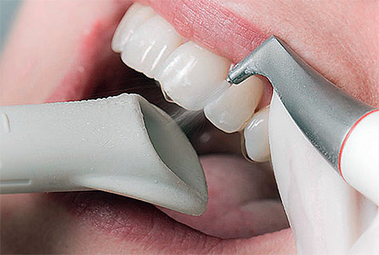 E aqui o processo de clareamento dos dentes (clareamento) pela tecnologia Air Flow já é mostrado.