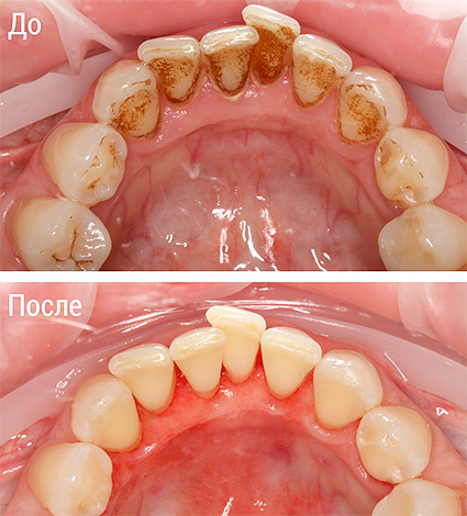 A foto mostra a aparência dos dentes antes e depois do procedimento de fluxo de ar.