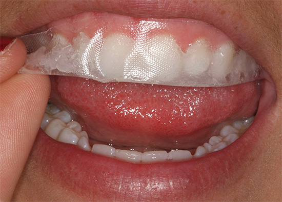 As tiras de clareamento são aplicadas aos dentes na área do sorriso.