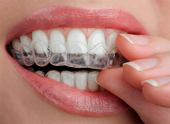 Para clarear o esmalte dos dentes em casa, também são usados ​​protetores bucais com um gel especial.