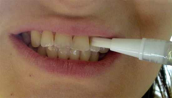 Um exemplo de aplicação de gel de um lápis clareador nos dentes.